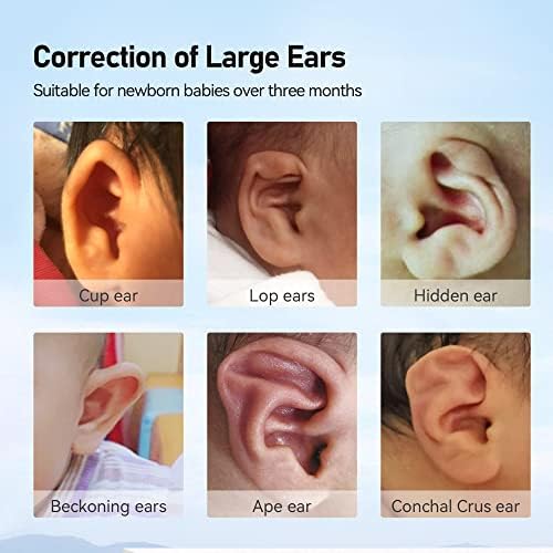SANFE Коректор оттопыренных уши на СЛОН Корекция големи уши Естетически коректори ушите на Новороденото Ортопедични